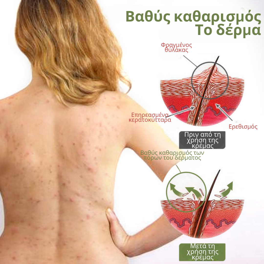 Κρέμα επεξεργασίας Flysmus Keratosis για βαθιά καθαρισμένη και λεία επιδερμίδα