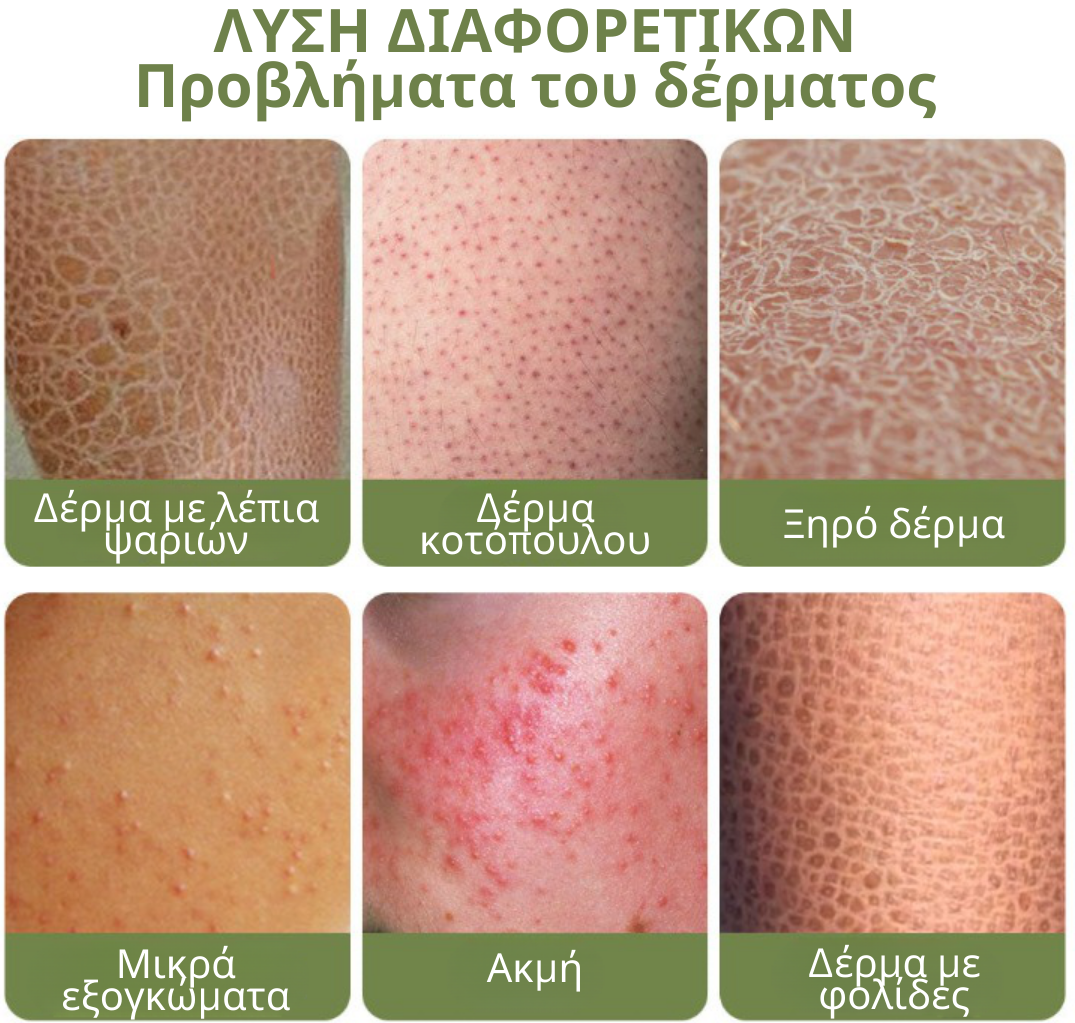 Κρέμα επεξεργασίας Flysmus Keratosis για βαθιά καθαρισμένη και λεία επιδερμίδα