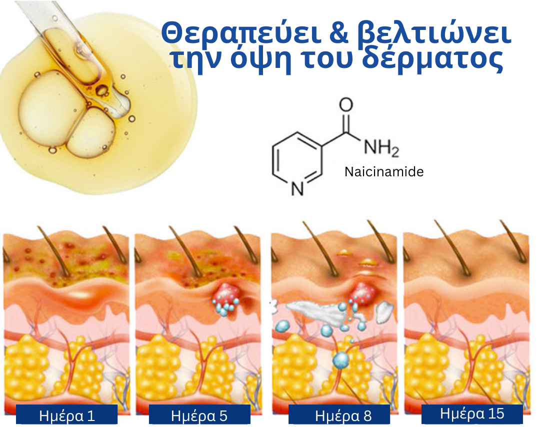 Σπρέι θεραπείας εκζέματος GFOUK