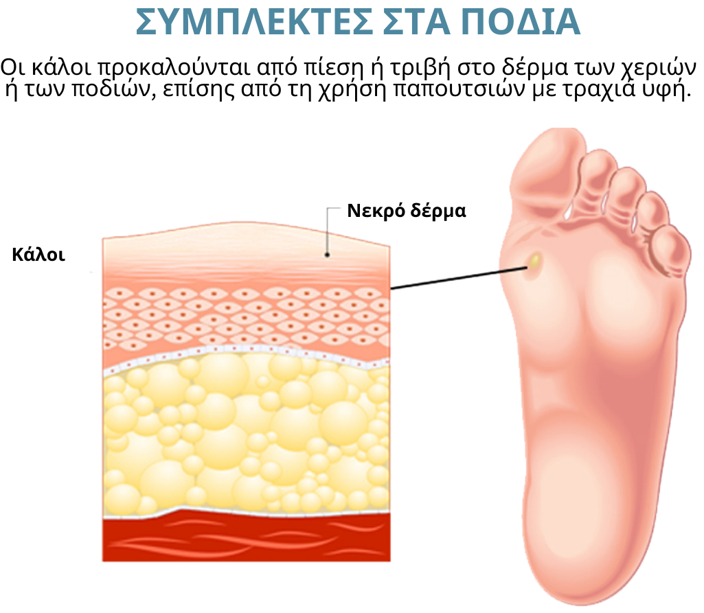 ATTDX Θεραπεία Πλαστικής Αφαίρεσης Κάλων και Καλλούν