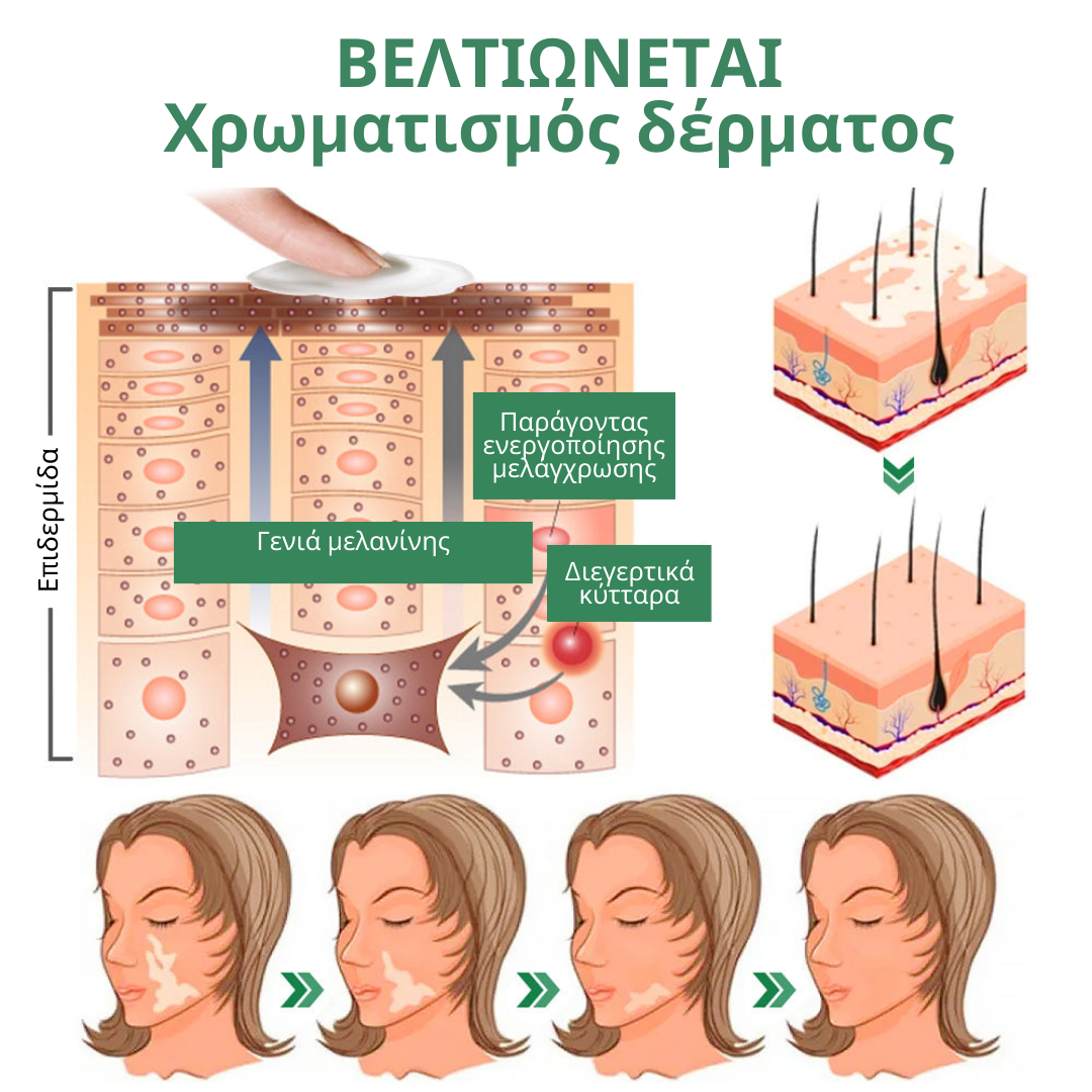 Κρέμα GFOUK™ TreatVitiligo για ανακούφιση