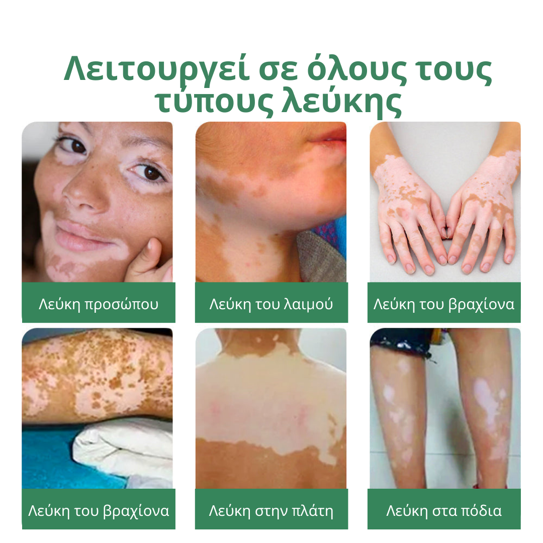 Κρέμα GFOUK™ TreatVitiligo για ανακούφιση