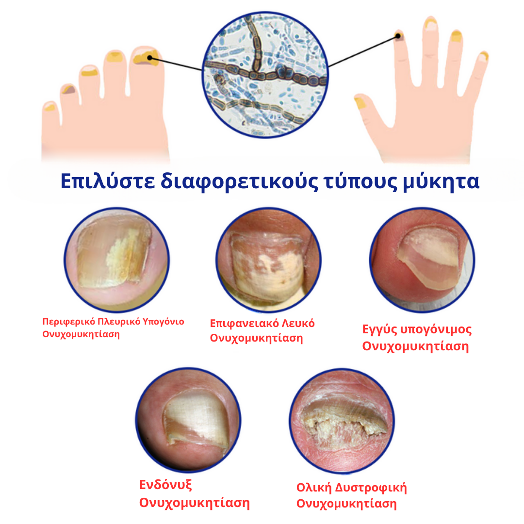 Ορός θεραπείας GFOUK™ για γρήγορη ανάπτυξη των νυχιών